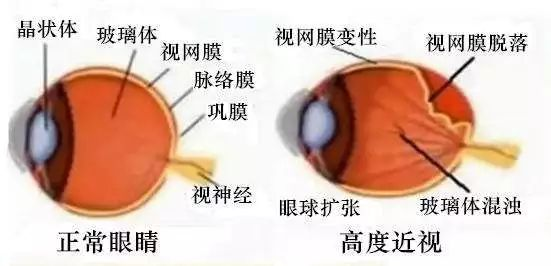 大众科普——这才是高度近视不能参与献血的原因